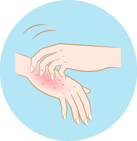 湿疹が出ている手のイラスト