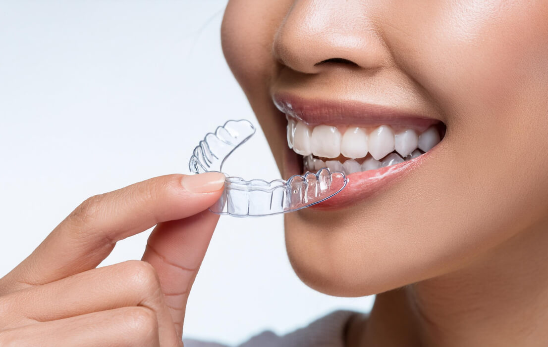 マウスピース矯正を取り外す女性
