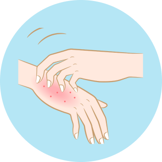 湿疹が出ている手のイラスト